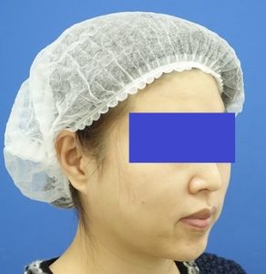 After 1m 顔 ななめ