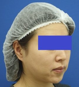 Before 顔 ななめ