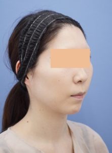 after_1m_naname_migi